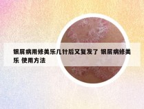 银屑病用修美乐几针后又复发了 银屑病修美乐 使用方法