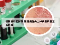 银屑病引起掉发 银屑病在头上掉头发严重怎么回事