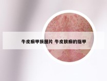 牛皮癣甲损图片 牛皮肤癣的指甲