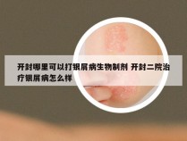 开封哪里可以打银屑病生物制剂 开封二院治疗银屑病怎么样