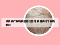 银屑病打生物制剂能吃蟹吗 银屑病打了生物制剂