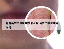 患有关节型银屑病该怎么办 关节型银屑病好治吗