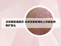 点状银屑病用药 点状性银屑病吃上药就能抑制扩散么