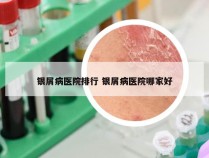 银屑病医院排行 银屑病医院哪家好