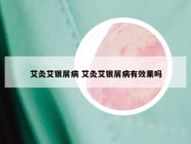 艾灸艾银屑病 艾灸艾银屑病有效果吗