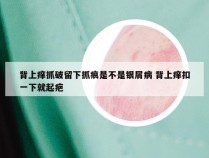背上痒抓破留下抓痕是不是银屑病 背上痒扣一下就起疤