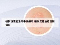 榆树枝液能治疗牛皮癣吗 榆树皮能治疗皮肤病吗