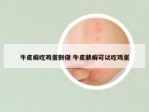 牛皮癣吃鸡蛋刺挠 牛皮肤癣可以吃鸡蛋