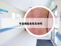 牛皮癣能危机生命吗