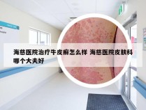海慈医院治疗牛皮癣怎么样 海慈医院皮肤科哪个大夫好