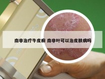 南非治疗牛皮癣 南非叶可以治皮肤病吗