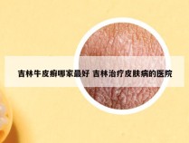 吉林牛皮癣哪家最好 吉林治疗皮肤病的医院