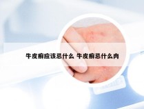 牛皮癣应该忌什么 牛皮癣忌什么肉