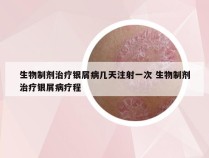 生物制剂治疗银屑病几天注射一次 生物制剂治疗银屑病疗程