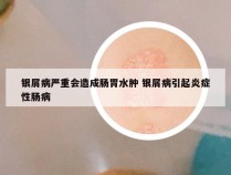 银屑病严重会造成肠胃水肿 银屑病引起炎症性肠病