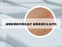 副银屑病的诊断及治疗 副银屑病怎么治疗的