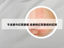 牛皮癣与红斑狼疮 皮癣和红斑狼疮的区别