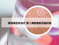 银屙病怎拌治疗 银莦病擦哪些药最好因