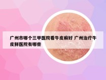 广州市哪个三甲医院看牛皮癣好 广州治疗牛皮鲜医院有哪些