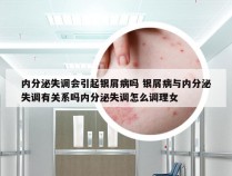 内分泌失调会引起银屑病吗 银屑病与内分泌失调有关系吗内分泌失调怎么调理女