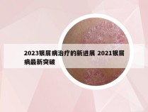 2023银屑病治疗的新进展 2021银屑病最新突破