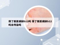 得了银屑病缺b12吗 得了银屑病缺b12吗会传染吗