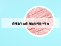 商陆治牛皮癣 商陆如何治疗牛皮