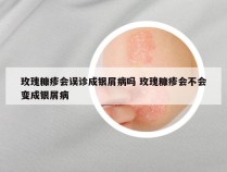 玫瑰糠疹会误诊成银屑病吗 玫瑰糠疹会不会变成银屑病