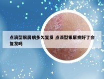 点滴型银屑病多久复发 点滴型银屑病好了会复发吗