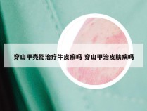 穿山甲壳能治疗牛皮癣吗 穿山甲治皮肤病吗