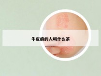 牛皮癣的人喝什么茶