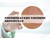天津武警医院能治牛皮癣吗 天津武警医院附属医院皮肤科怎么样