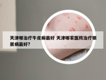 天津哪治疗牛皮癣最好 天津哪家医院治疗银屑病最好?