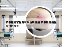 长春在哪家医院可以治银屑病 长春银屑病医院预约挂号