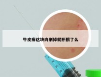 牛皮癣这块肉削掉就断根了么