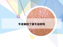 牛皮癣的了就不会好吗