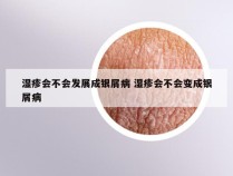湿疹会不会发展成银屑病 湿疹会不会变成银屑病