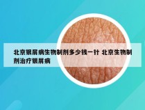 北京银屑病生物制剂多少钱一针 北京生物制剂治疗银屑病