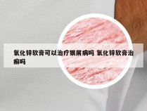 氧化锌软膏可以治疗银屑病吗 氧化锌软膏治癣吗