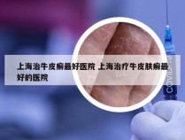 上海治牛皮癣最好医院 上海治疗牛皮肤癣最好的医院