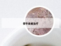 得牛皮癣治疗