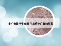 小广告治疗牛皮癣 牛皮癣小广告的危害