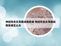 神经性皮炎发展成银屑病 神经性皮炎发展成银屑病怎么办