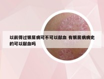 以前得过银屑病可不可以献血 有银屑病病史的可以献血吗