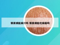 银屑病能麻汁吗 银屑病能吃麻酱吗