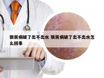 银屑病破了出不出水 银屑病破了出不出水怎么回事