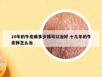 10年的牛皮癣多少钱可以治好 十几年的牛皮鲜怎么治