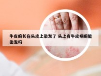 牛皮癣长在头皮上染发了 头上有牛皮病癣能染发吗