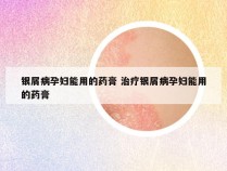 银屑病孕妇能用的药膏 治疗银屑病孕妇能用的药膏
