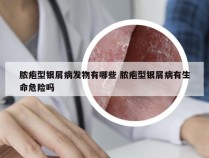 脓疱型银屑病发物有哪些 脓疱型银屑病有生命危险吗